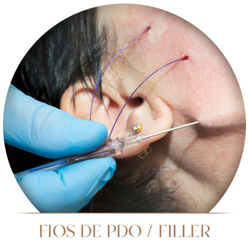 Fios de PDO / Filler